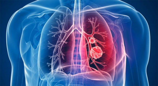Информационная кампания по борьбе с раком лёгкого в Коломне