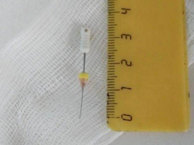 Коломенец проглотил стоматологический инструмент