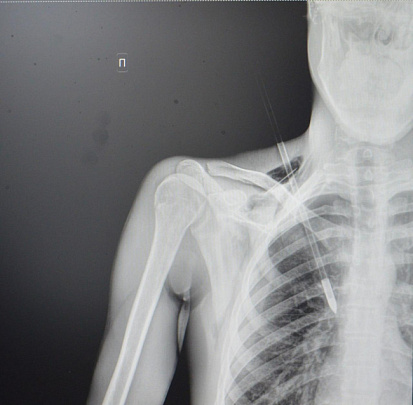 В Ступино хирурги извлекли стрелу из грудной клетки молодого человека