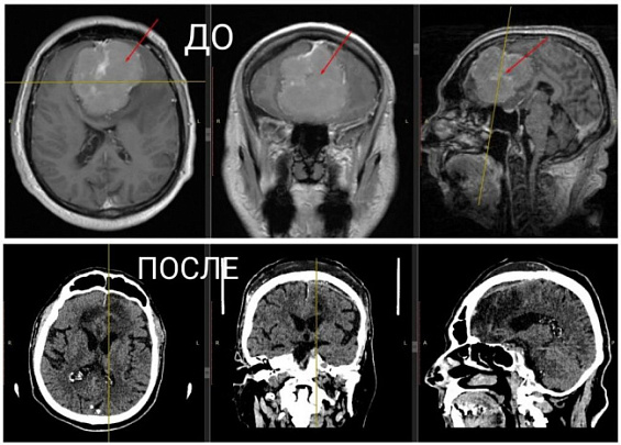 В Коломне мужчине удалили опухоль мозга размером с теннисный мяч